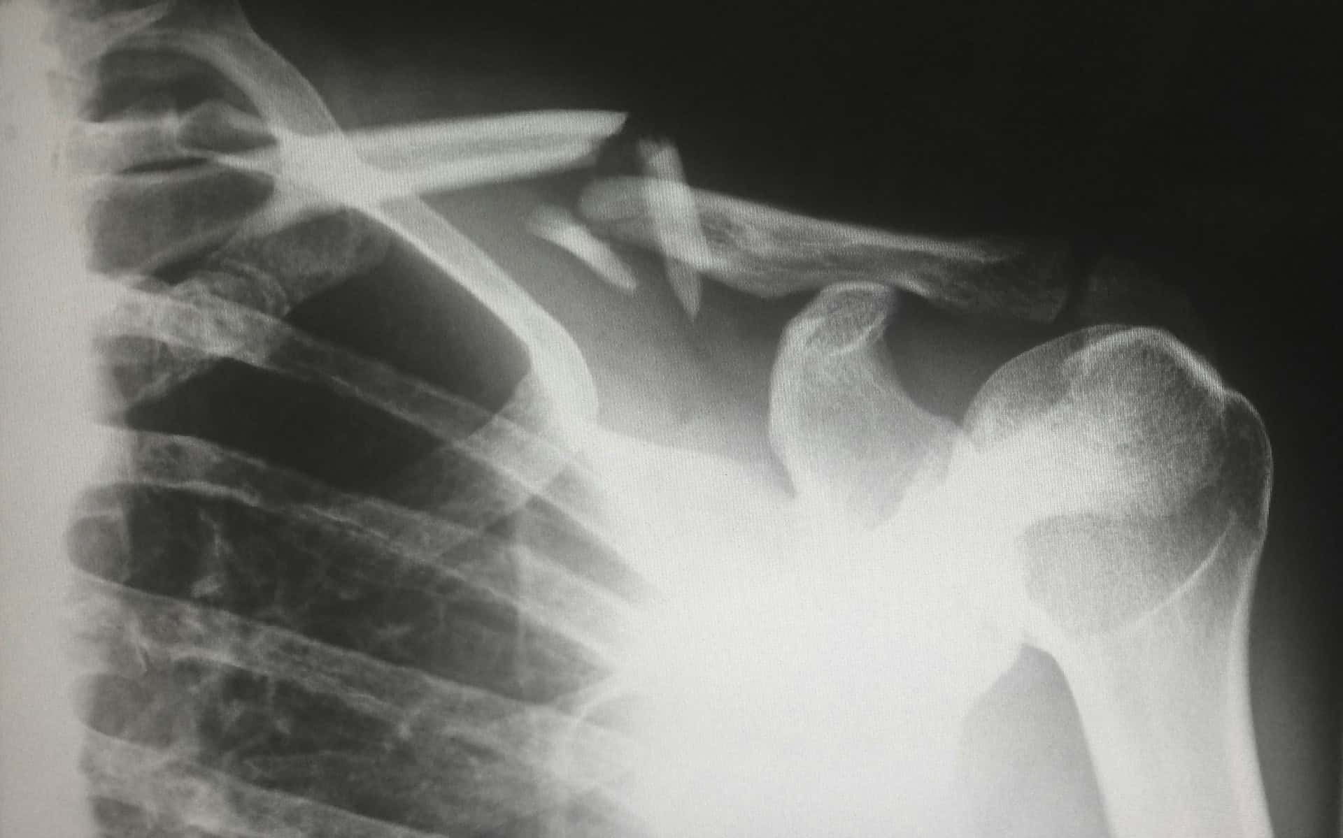Broken Bone in X-Ray